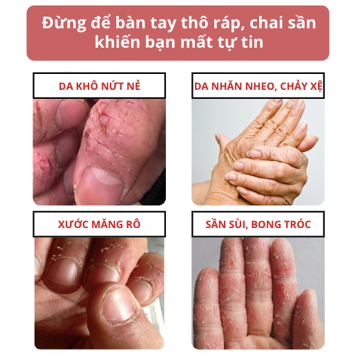 Tinh chất Rose Manor - phục hồi trẻ hóa da tay Rose Manor giảm chai sần đốt tay, xóa nhăn da tay, dưỡng móng chắc khoẻ