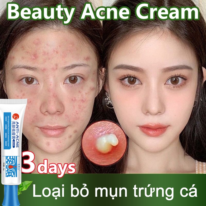 【Mua 2 tặng 1】Kem mụn Ẩn mụn Viêm Đỏ mụn Bọc mụn đầu đen dành cho mặt,THÂM sau khi hết mụn 25g