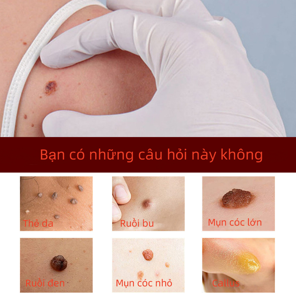 Kem Tẩy Nốt Ruồi Loại Bỏ Mụn Cóc, Mụn Cơm, Mụn Thịt, Mụn Cóc Jaysuing - Kem Jaysuing Sạch Mụn Thịt Dư Không Sẹo Tại Nhà