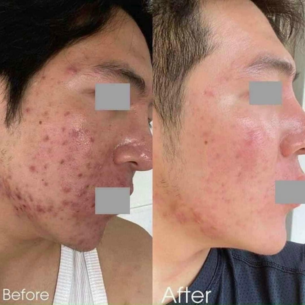 Gigi Bioplasma Azelaic Cream 15% - Kem giảm mụn và thâm nám 30ml