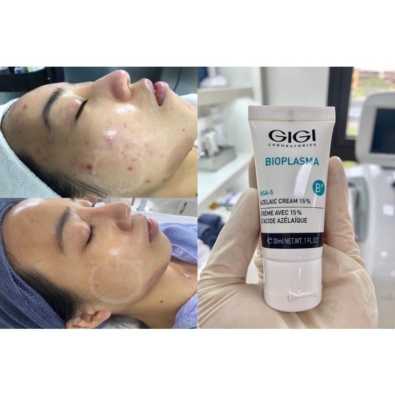 Gigi Bioplasma Azelaic Cream 15% - Kem giảm mụn và thâm nám 30ml
