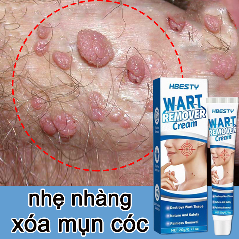 Sùi mào gà,Kem xóa mụn cóc mụn cóc mụn cơm dạng phẳng, dạng sợi [Hbesty] Removal