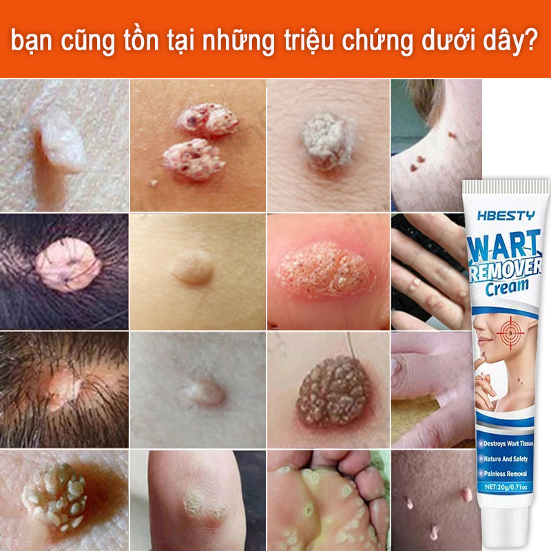 Sùi mào gà,Kem xóa mụn cóc mụn cóc mụn cơm dạng phẳng, dạng sợi [Hbesty] Removal