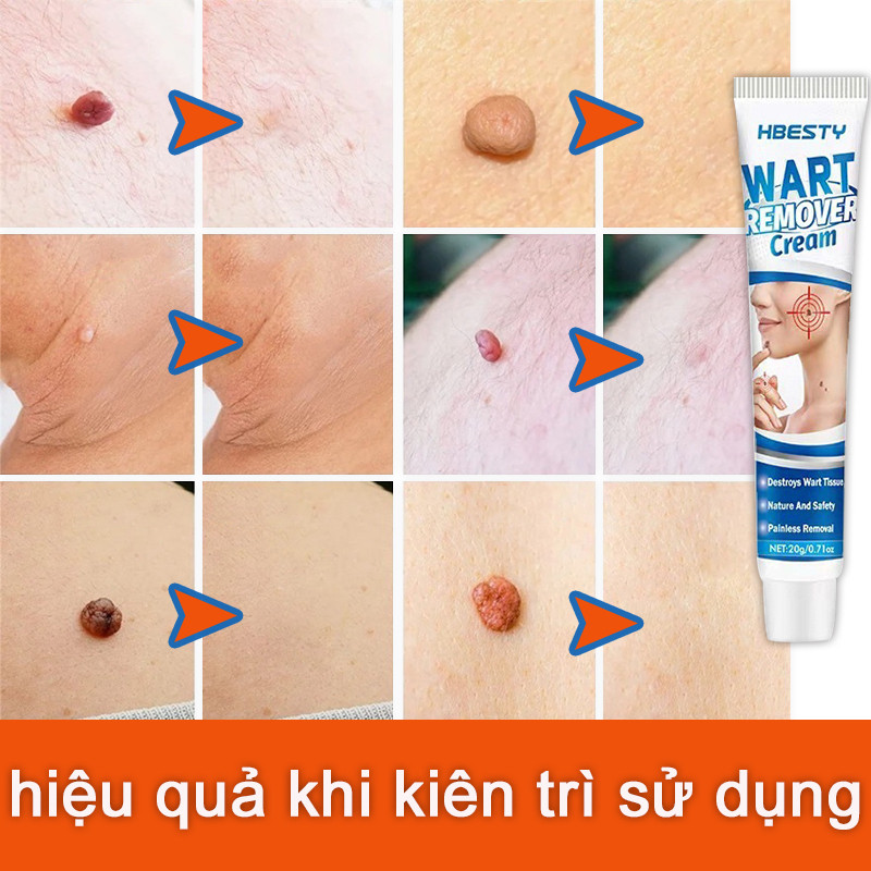 Sùi mào gà,Kem xóa mụn cóc mụn cóc mụn cơm dạng phẳng, dạng sợi [Hbesty] Removal