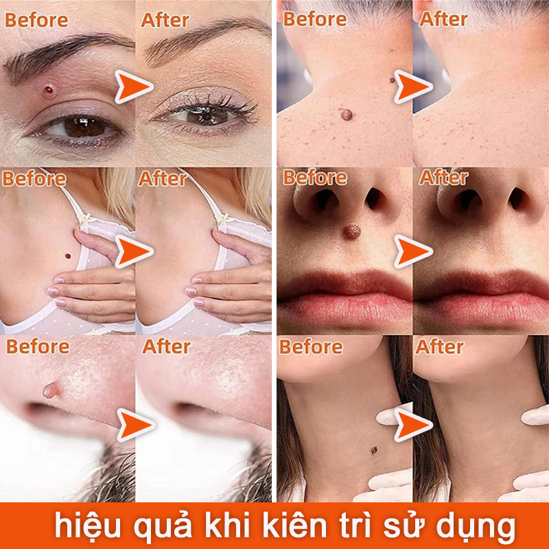 Sùi mào gà,Kem xóa mụn cóc mụn cóc mụn cơm dạng phẳng, dạng sợi [Hbesty] Removal