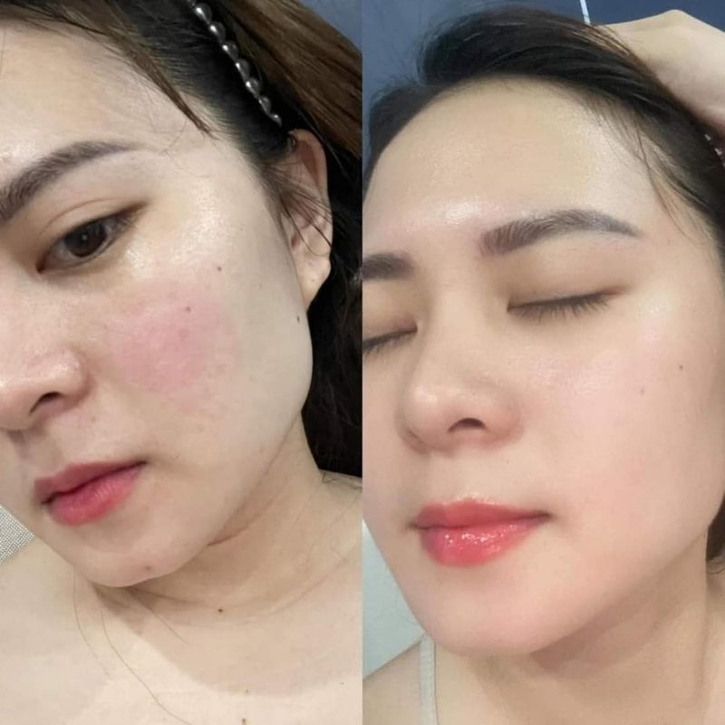 Tinh chất Niacinamide Lumiderm 30ml