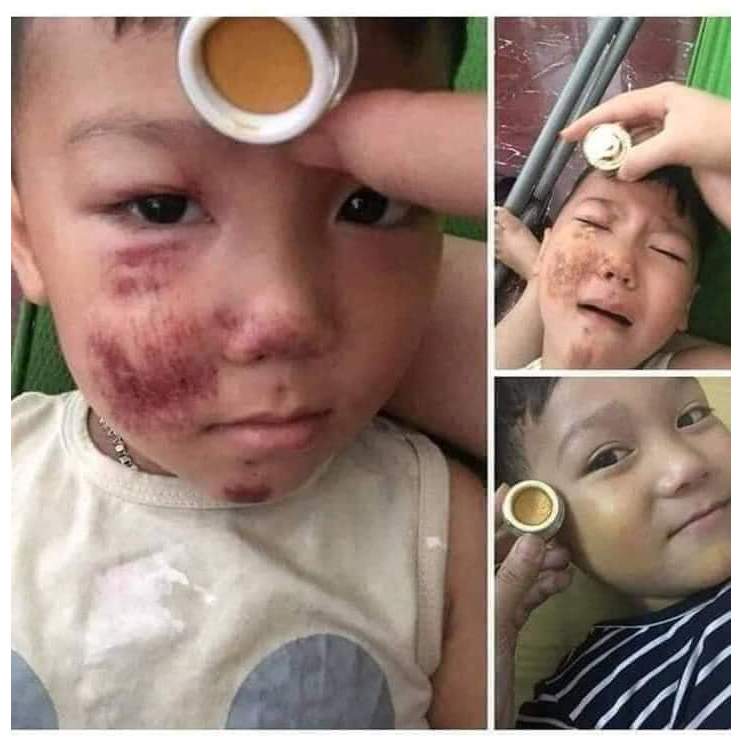 CAO NGHỆ MAGIC SKiN ,Cao nghệ ngừa thâm sẹo