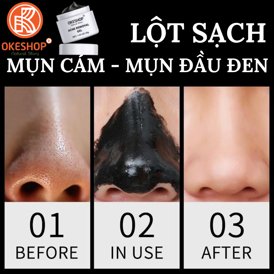 Gel Lột Mụn Nha Đam OKESHOP 30ml - Giải Pháp Loại Bỏ Mụn Đầu Đen - Mụn Cám - Bạ Nhờn - Sạch Sâu Và Thu Nhỏ Lỗ Chân Lông