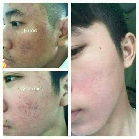 (Tặng kèm brm) Thảo dược Sunnary  Tái Tạo Da - Serum Giảm Mụn Thâm Rỗ - Đánh Bay Tất Cả Các Loại Mụn, Mờ Nám, Tàn Nhan