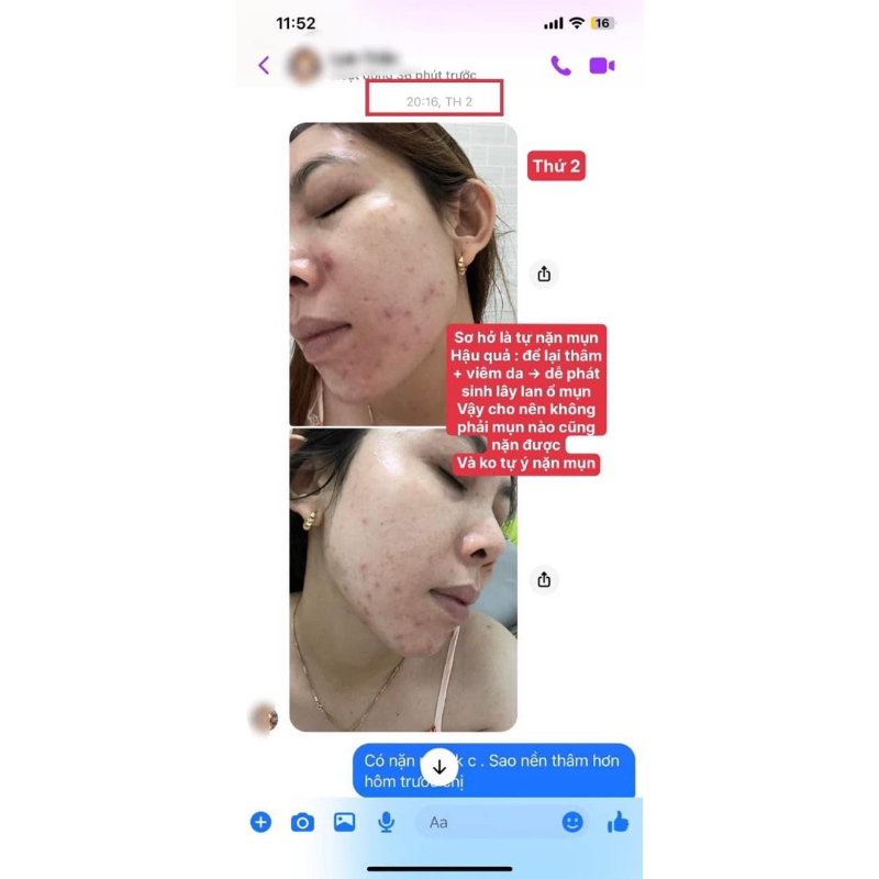 -SKINOREN 20% hàng chính hãng đủ bill