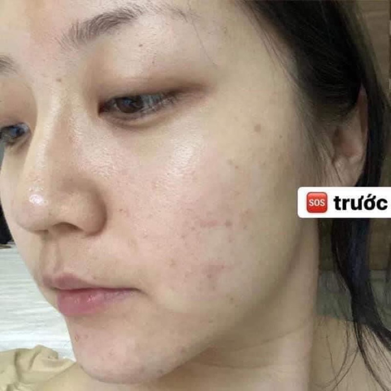 -SKINOREN 20% hàng chính hãng đủ bill