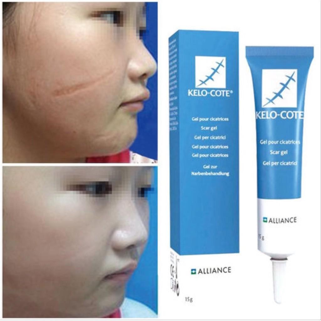 Gel xoá sẹo lồi, sẹo thâm, sẹo rỗ, sẹo lâu năm Kelo-Cote 6g