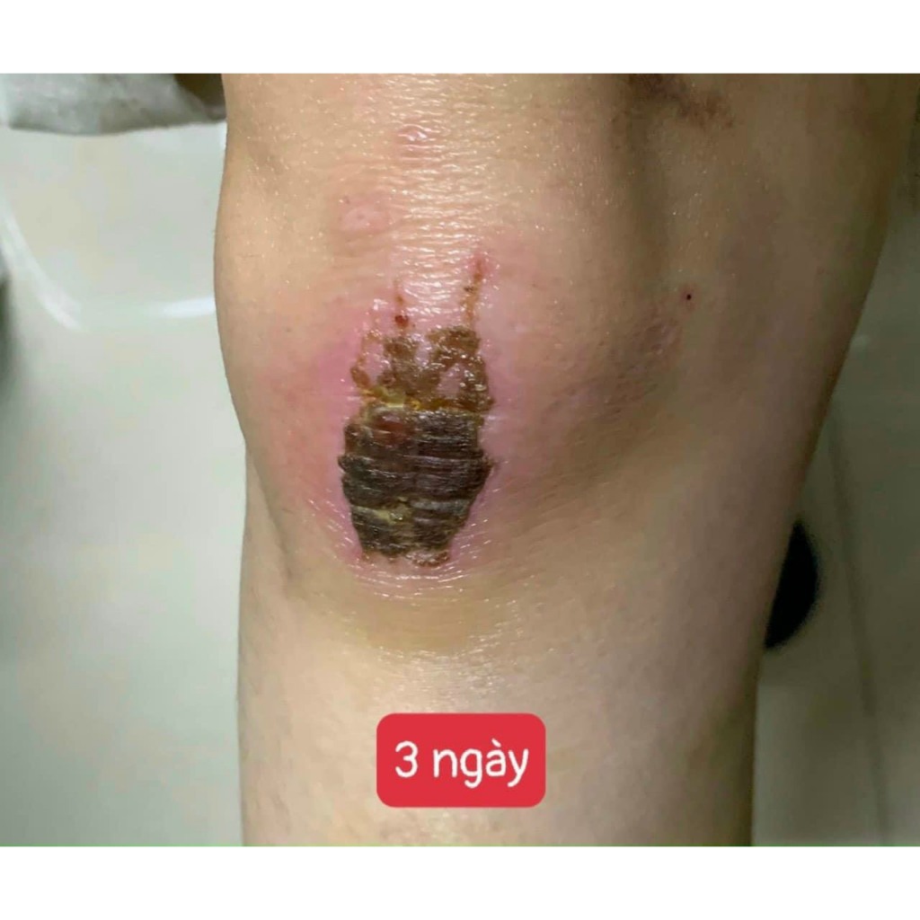 Gel xoá sẹo lồi, sẹo thâm, sẹo rỗ, sẹo lâu năm Kelo-Cote 6g