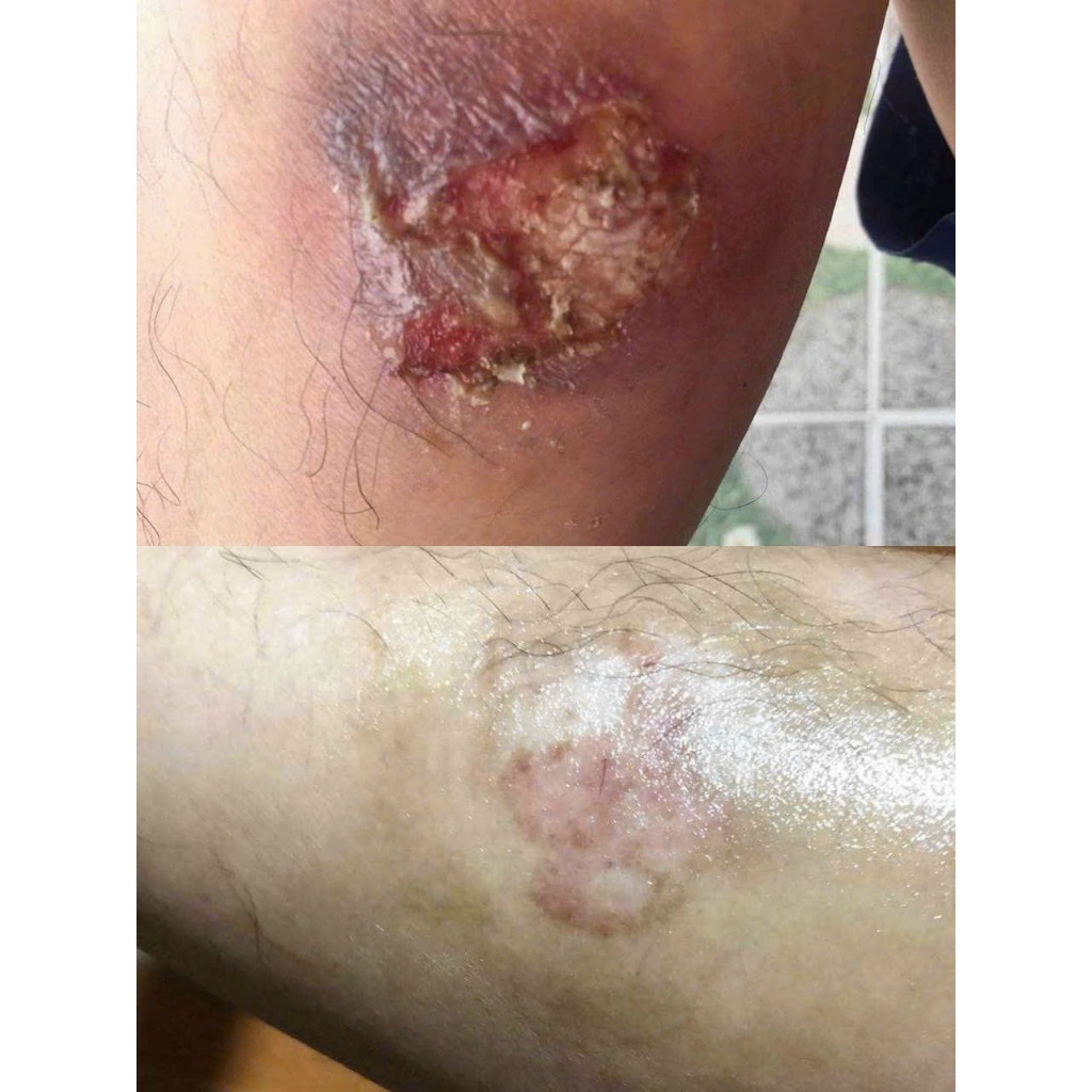 Gel xoá sẹo lồi, sẹo thâm, sẹo rỗ, sẹo lâu năm Kelo-Cote 6g