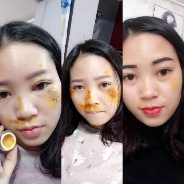 Kem ngừa thâm Magic skin Anti Bruise Cream