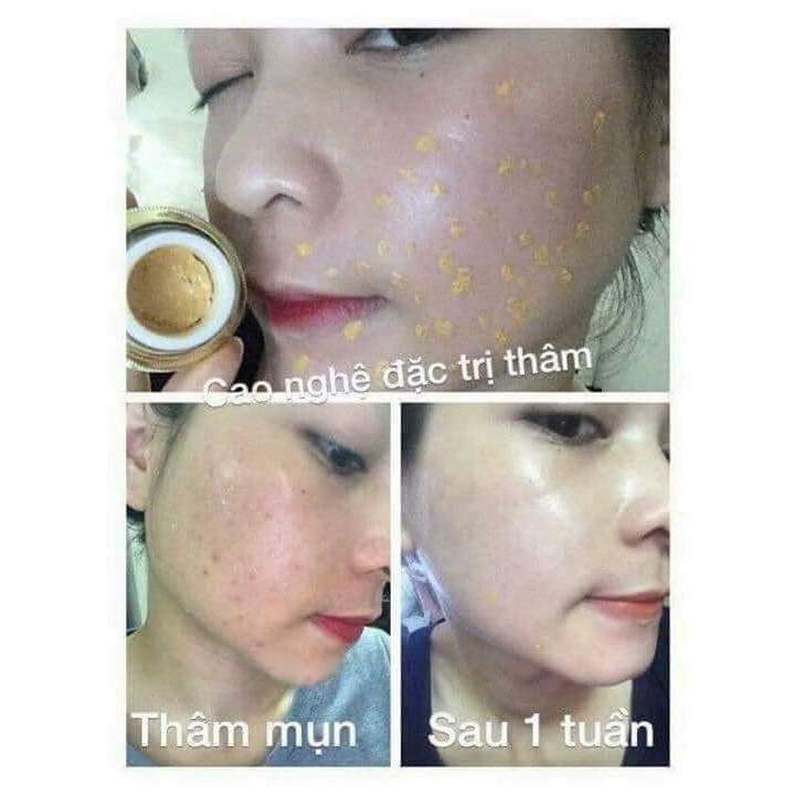 Kem ngừa thâm Magic skin Anti Bruise Cream