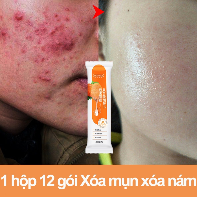 Mặt nạ làm trắng mặt nạ cà rốt Loại bỏ mụn trứng cá, kiểm soát dầu, làm sáng tông màu da, se khít lỗ chân lông
