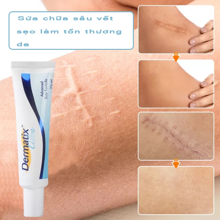 Gel Kem Làm Mờ Sẹo Thâm và làm phẳng sẹo lồi, loại bỏ vết sẹo muỗi đốt Pha loãng vết bỏng, vết sẹo cũ, Giúp Phục Hồi Da