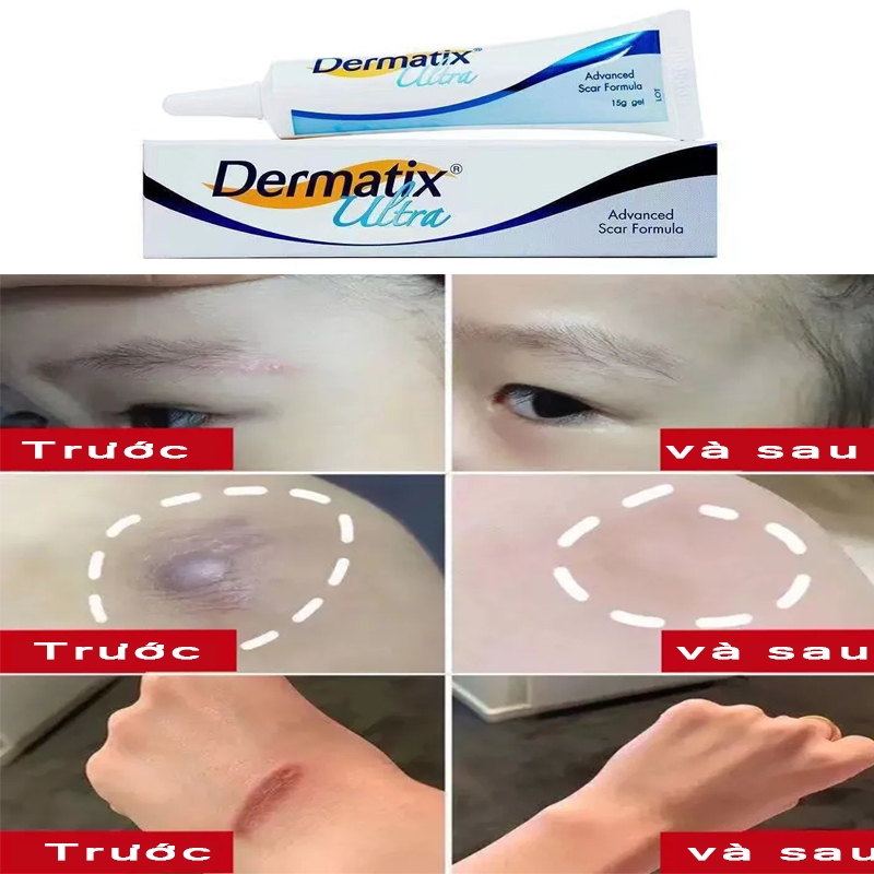 Gel Kem Làm Mờ Sẹo Thâm và làm phẳng sẹo lồi, loại bỏ vết sẹo muỗi đốt Pha loãng vết bỏng, vết sẹo cũ, Giúp Phục Hồi Da