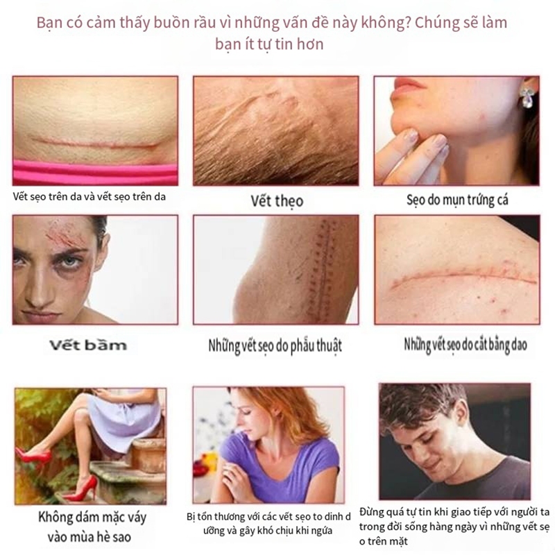 Gel Kem Làm Mờ Sẹo Thâm và làm phẳng sẹo lồi, loại bỏ vết sẹo muỗi đốt Pha loãng vết bỏng, vết sẹo cũ, Giúp Phục Hồi Da