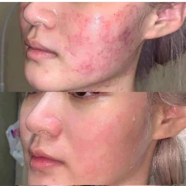 Mặt Nạ B5 Phục Hồi Da Sau Lazer, Peel Da, Lăn Kim, Phi Kim Và Cấp Ẩm Cho Da