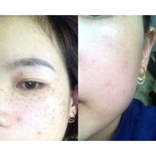 Serum Chấm Nám, Tàn Nhang