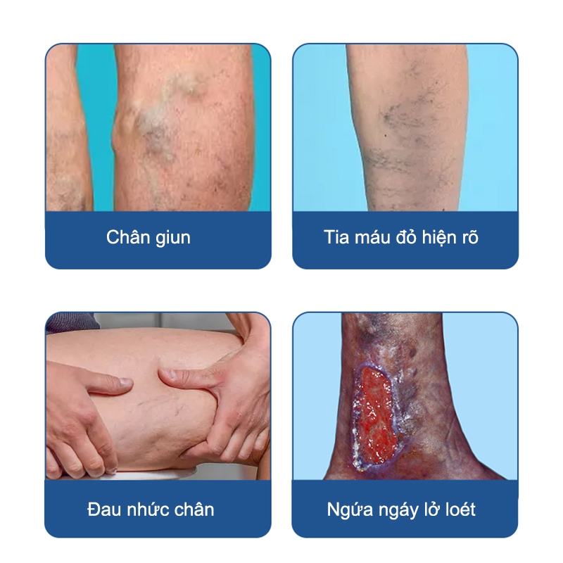 Kem Suy Giãn Tĩnh Mạch HBESTY Varicose Veins Cream - Kem Bôi Giãn Tĩnh Mạch Cải Thiện Lưu Thông Tĩnh Mạch