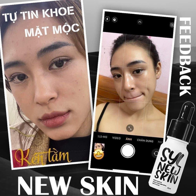 Tinh chất serum Kén Tằm New Skin ngừa mụn sau 2 tuần