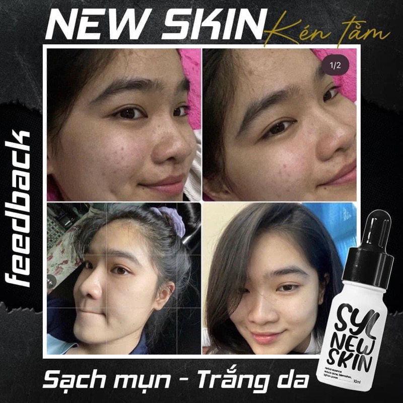 Tinh chất serum Kén Tằm New Skin ngừa mụn sau 2 tuần