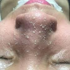 Mụn Đầu Đen Mụn Cám YOUNGERC 30ml | Đánh Bay Mụn Đầu Đen, Sạch Mụn Cám Nhanh Và Hiệu Quả