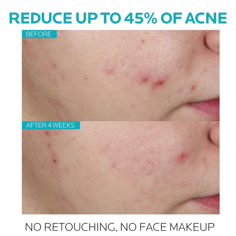 Serum tẩy tế bào chết LA ROCHE-POSAY Effaclar 1.5% Salicylic Acid Acne Treatment 30ml