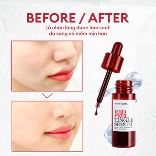 [PHIÊN BẢN MỚI] Tinh Chất Red Peel Tingle Serum 11ML