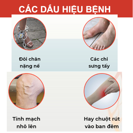 Kem Bôi Loại Bỏ Giãn Tĩnh Mạch Chân Tay Nga Varikosette Nga 75 ml