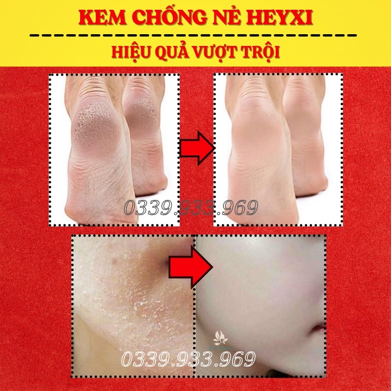 Kem Chống Nẻ , Kem Dưỡng Ẩm Chống Nứt Nẻ Da Heyxi 20g