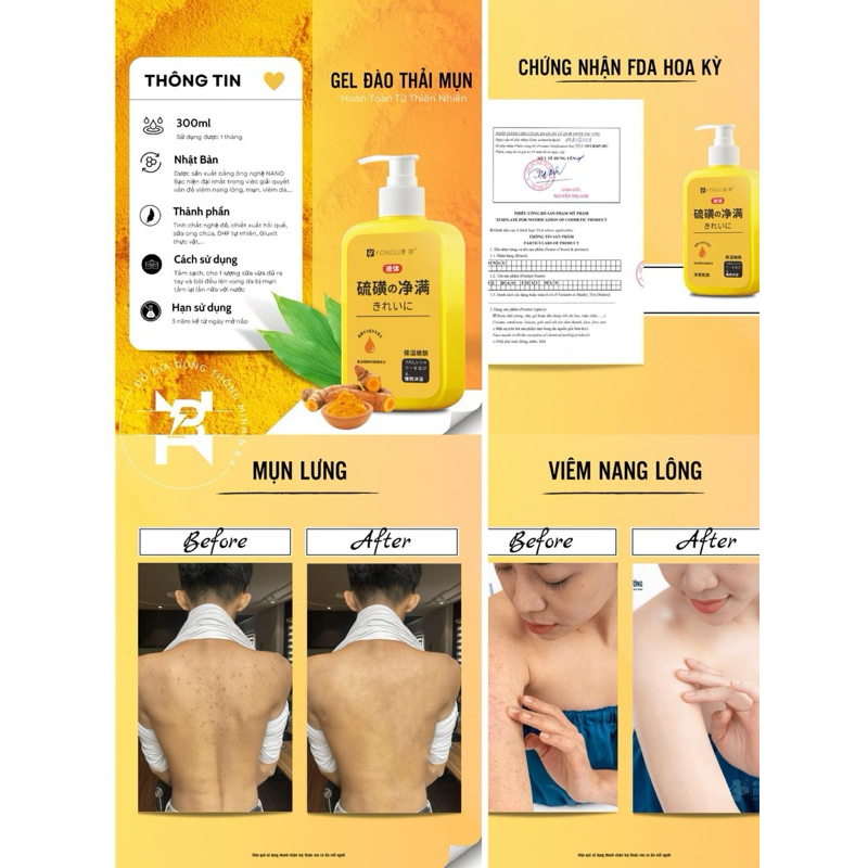 Gel đào thải mụn nghệ đỏ Yongu 300ml - Sữa tắm giảm mụn lưng, mụn body, không để lại thâm