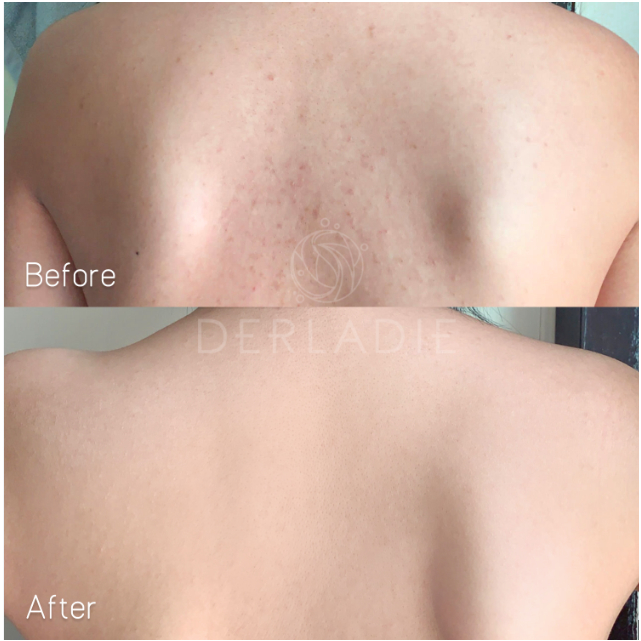 Xà Phòng Cơ Thể Derladie Body Cleansing Bar For Blemish Skin