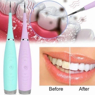 Máy lấy cao răng tại nhà - dụng cụ lấy cao răng thông minh