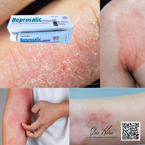 Beprosalic 15g kem bôi giảm Vẩy nến, Chàm, Da tiết bã, Nấm da - Mỹ phẩm chính hãng HOE.
