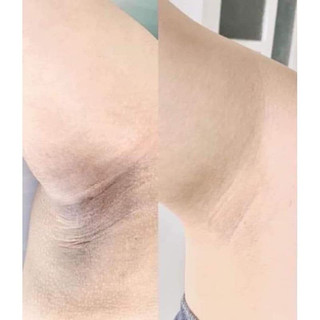 Kem khử thâm Nách, bẹn, mông A6