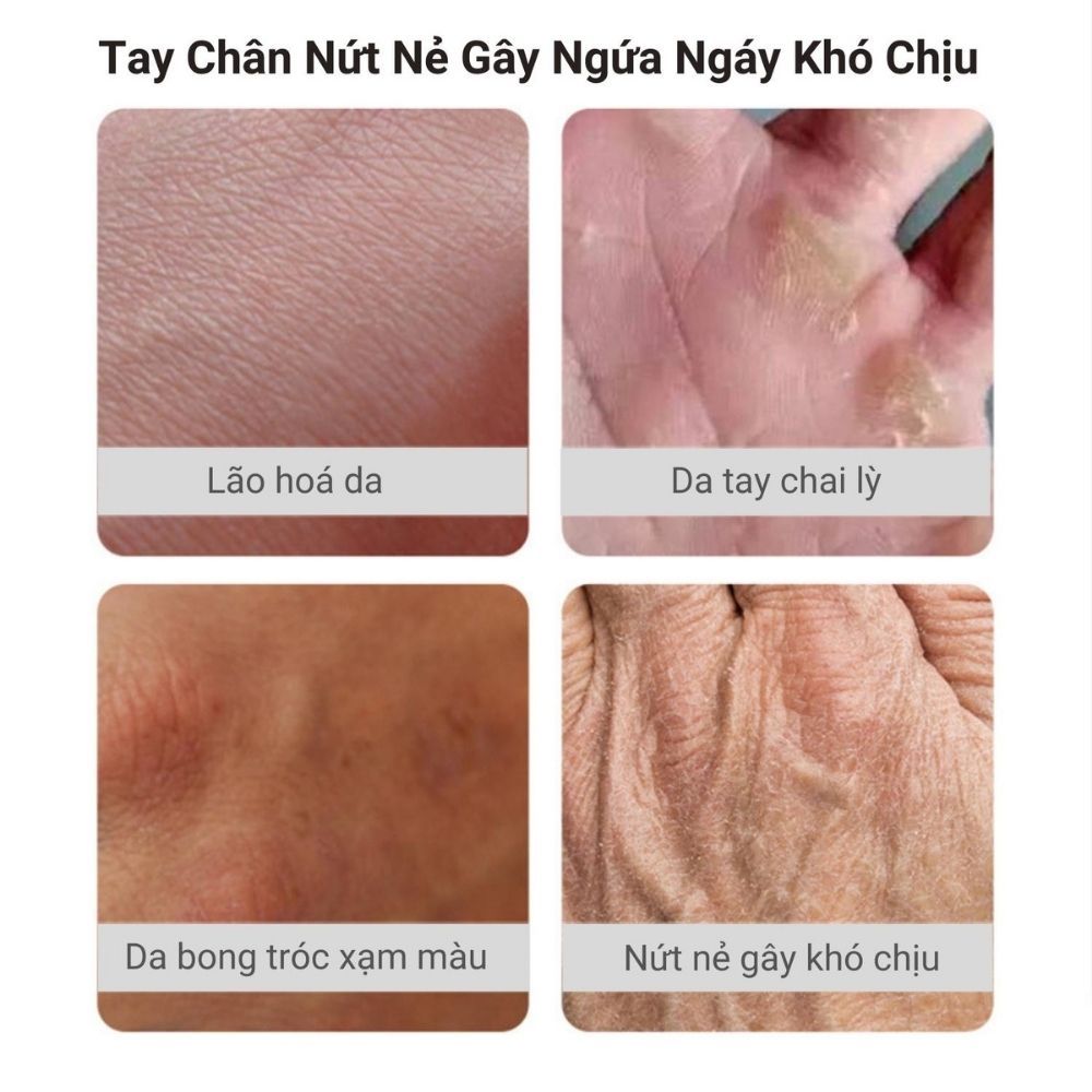 Kem Dưỡng Ẩm Chống Nứt Nẻ Gót Chân Tấm Thị, Kem Dưỡng Ẩm Ngăn Ngừa Gót Chân Heyxi