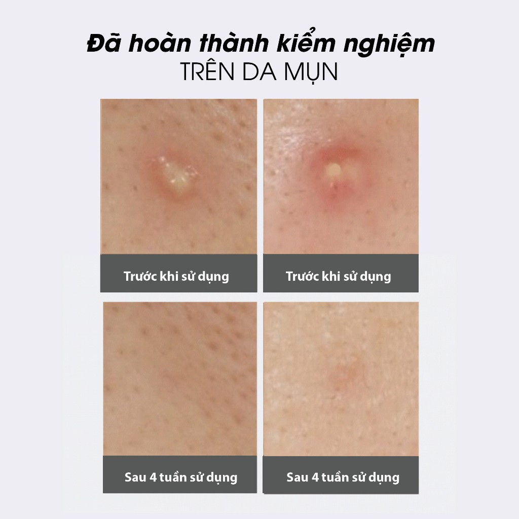 Bông Toner Cho Da Mụn AMPLE:N Acne Shot Toner Pad 60 Miếng