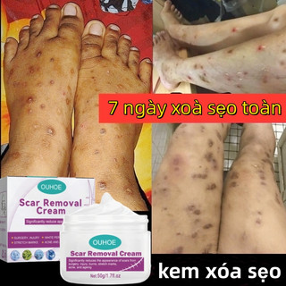 Kem xóa sẹo thâm sẹo phẫu thuật lồi lõm rỗ mờ thâm mụn rạn da ngừa mụn kem mờ sẹo lâu năm kem làm mờ sẹo thâm