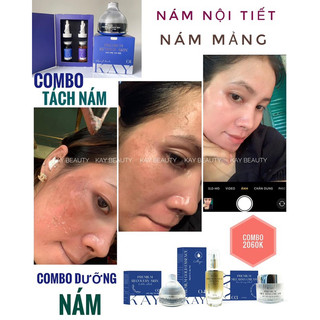 COMBO TRI NAM KAY BEAUTY ( kem peel + tách nám )
