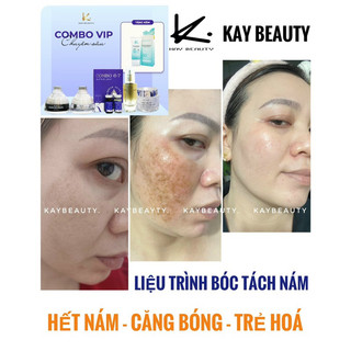 COMBO TRI NAM KAY BEAUTY ( kem peel + tách nám )