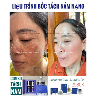 COMBO TRI NAM KAY BEAUTY ( kem peel + tách nám )