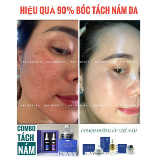 COMBO TRI NAM KAY BEAUTY ( kem peel + tách nám )