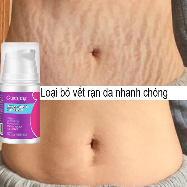 Kem rạn da (Xóa rạn da nhanh chóng trong 7 ngày)Kem xoá rạn da sau sinh làm mờ vết thâm tăng độ đàn hồi cho da làm trắng