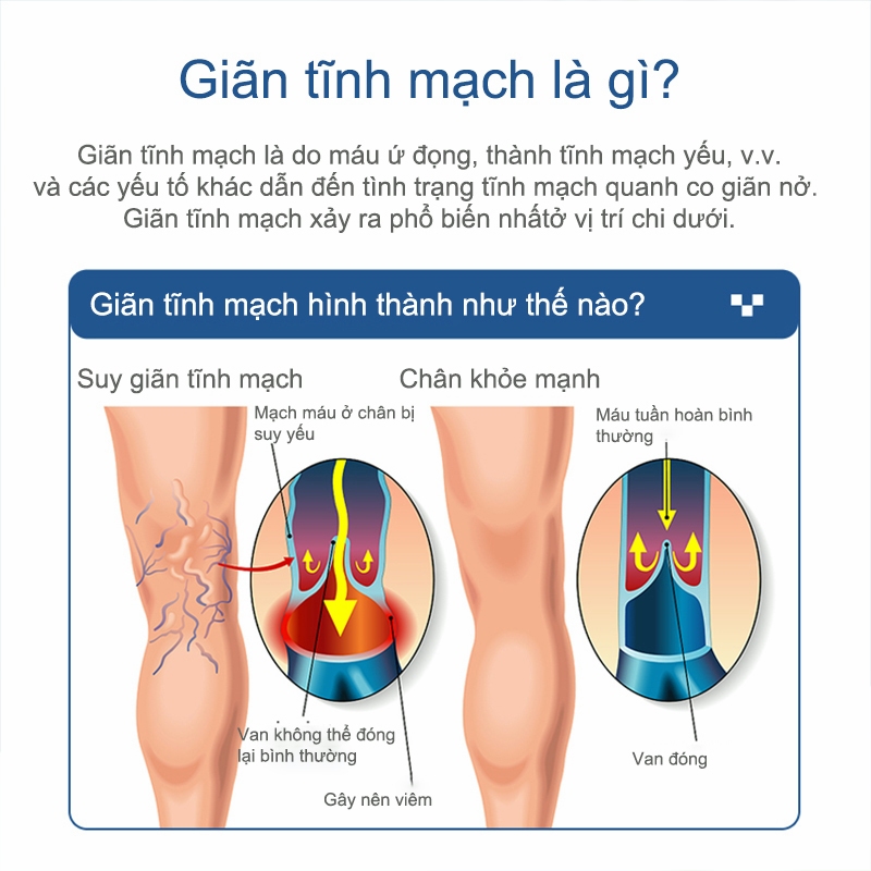 Giãn tĩnh mạch Kem chống suy giãn tĩnh mạch 20g Kem Bôi Dánh Bay Tắc Nghẽn Mao Mạch Varikosette giúp giảm đau mỏi
