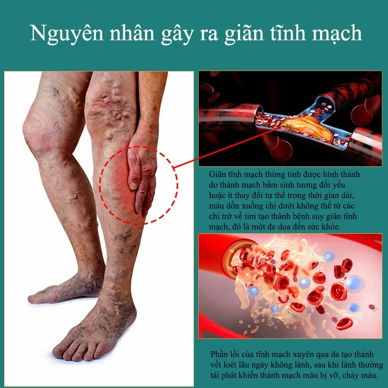 Giãn tĩnh mạch Kem chống suy giãn tĩnh mạch 20g Kem Bôi Dánh Bay Tắc Nghẽn Mao Mạch Varikosette giúp giảm đau mỏi