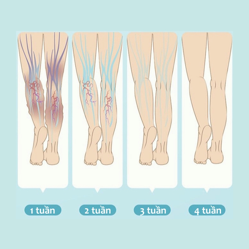 Giãn tĩnh mạch Kem chống suy giãn tĩnh mạch 20g Kem Bôi Dánh Bay Tắc Nghẽn Mao Mạch Varikosette giúp giảm đau mỏi